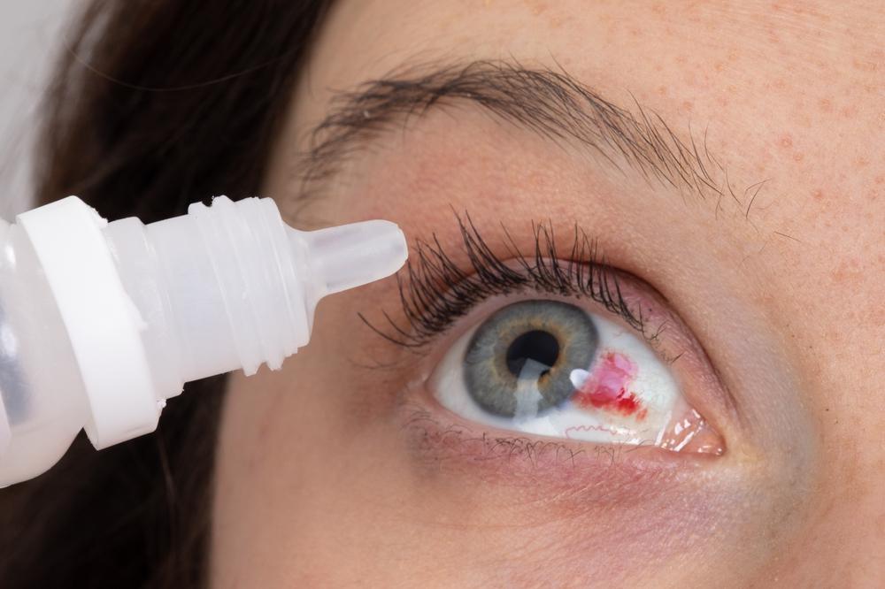 Các nguyên nhân phổ biến gây đau mắt đỏ (P2)